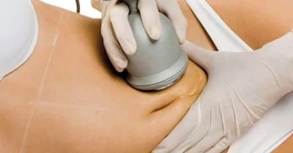  Ультрозвуковая КАВИТАЦИЯ ,. RF лифтинг